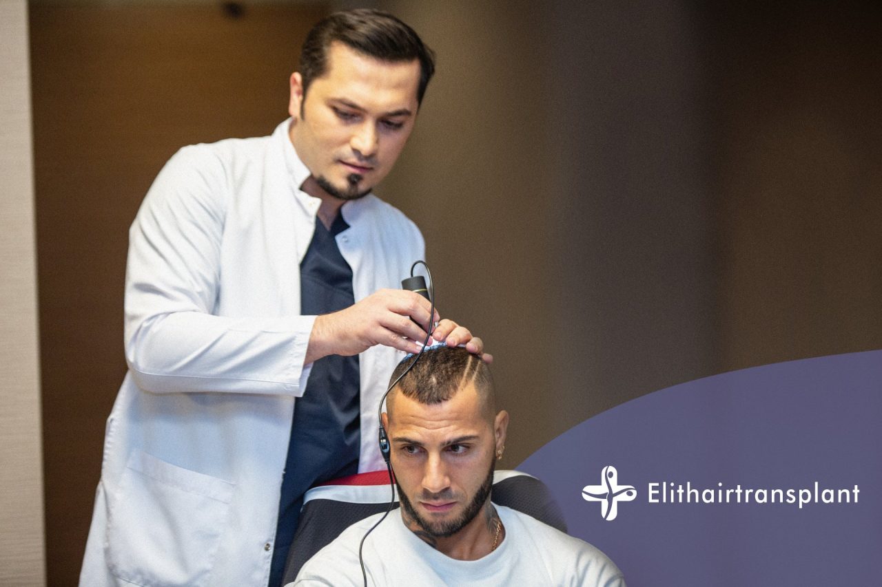 Gli italiani scelgono Istanbul per il trapianto di capelli: il motivo è il costo