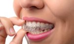 Ortodonzia per adulti: non è mai troppo tardi per tornare a sorridere al meglio