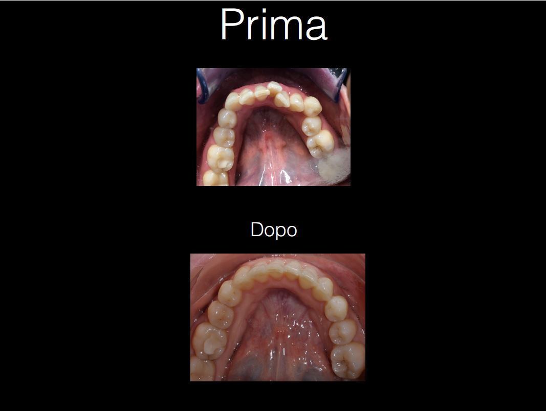 mezzena_prima-dopo_1