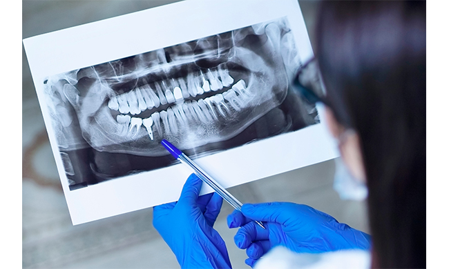 Implantologia: come misurare la stabilità dell’impianto