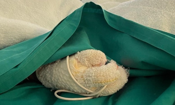 Bambini ustionati all’asilo di Osio Sopra: “Ale ed Elisa non avranno mai più la vita di prima”
