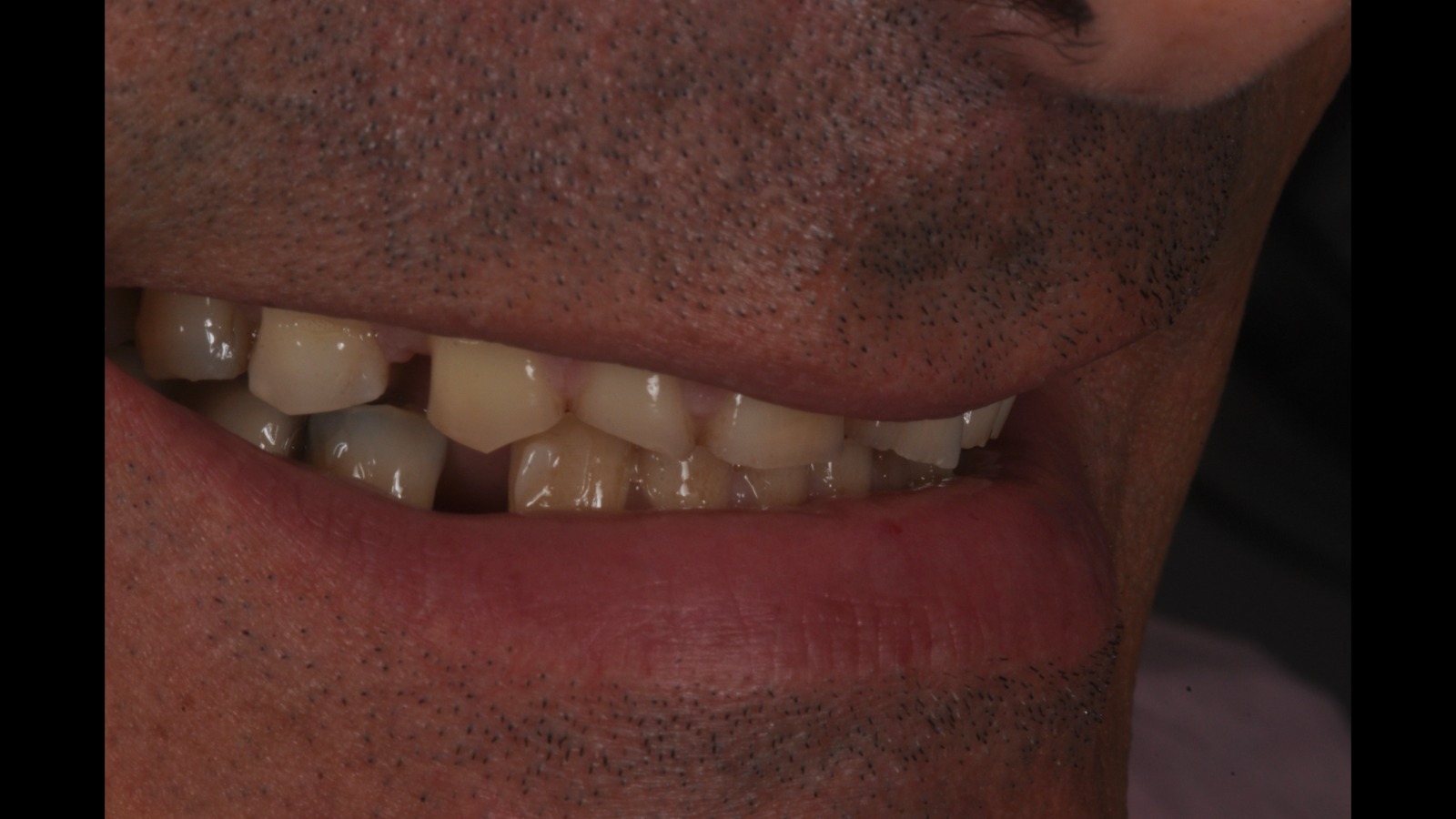 Agli Studi Mezzena giornata dedicata alle faccette dentali - Prima Treviglio