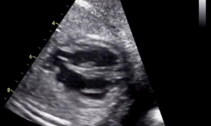 Anomalie cardiache nel feto: a Bergamo si riunisce il gotha della cardiologia pediatrica