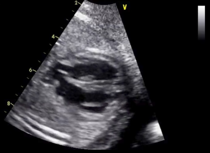 Anomalie cardiache nel feto: a Bergamo si riunisce il gotha della cardiologia pediatrica
