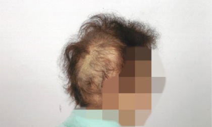 Venti giorni dopo shampoo e tinta comincia a perdere i capelli: parrucchiere di Treviglio "sotto accusa"