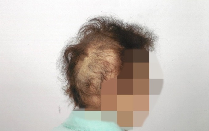 Venti giorni dopo shampoo e tinta comincia a perdere i capelli: parrucchiere di Treviglio “sotto accusa”