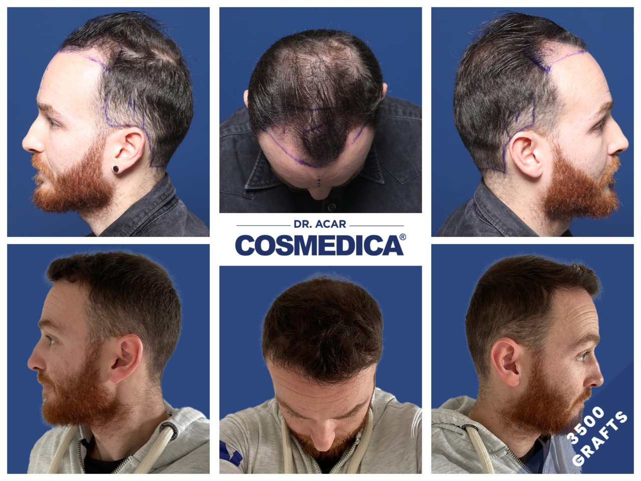 Trapianto capelli in Turchia: guida definitivaTrapianto capelli in Turchia: guida definitiva