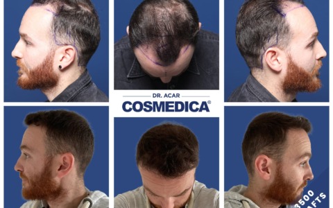 Trapianto capelli in Turchia: guida definitivaTrapianto capelli in Turchia: guida definitiva